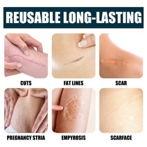 여드름 흉터 제거 크림 스트레치 젤 스무딩 바디 스킨 케어 촉진 세포 재생 GMP 인증 50g, 한개옵션0