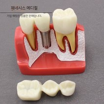치아 모형 치과 교육용 병원 치석 이빨 임플란트 구강 입모형 재료상, A. 빨간색
