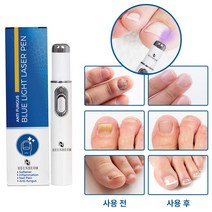 HEUNBEOM 발톱 레이저 가정용 손톱 관리 레이저 복원 제균 살균 간호기기, 1개