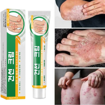 건선약 손 손가락 발 두피 건선 연고 크림 가려움 20g, 1개