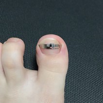 버클식 내성발톱교정기 내향성발톱 자가치료