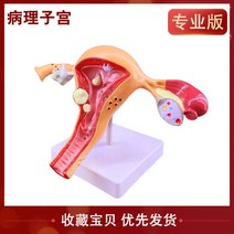 자궁 모형 난소 질 여성 내부 및 외부 생식 기관 모델 생식 부서 산부인과, 병적 자궁 + 1개