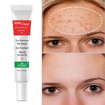 여드름크림 피부트러블 치료제 여드름흉터크림 청소년 성인용 스킨케어제