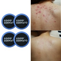 굿더마토 멘톨+ 데코르테 바디바 115g (등드름바디바 천연수제비누 몸드름엉드름가드름 닭살좁쌸모낭충 햇빛알러지), 4개