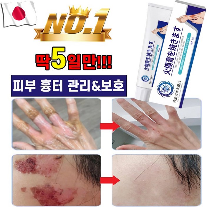 일본기술 1/1+1 화상 연고 흉터 상처 제거  재생 크림 피부 관리 케어