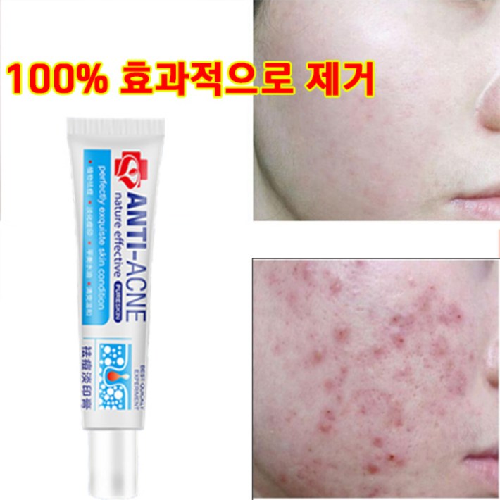 [국내배송/100%제거]여드름 연고 좁쌀여드름 여드름흉터 리페어 크림 스테로이드 프리 천연 식물 성분 여드름흉터연고